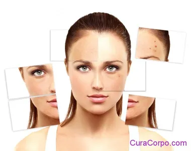 rosacea, couperose